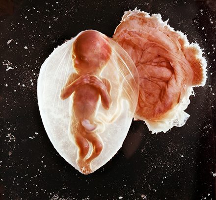 fetus at 20 weeks gestation covered by vernix in amniotic sack