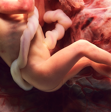 a close-up of the umbilical cord around a fetus at 28 weeks gestation