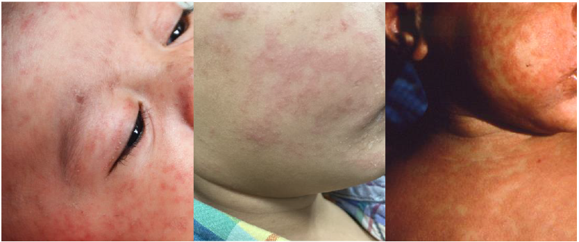 three examples of measles rash